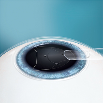 角膜の縁を約3mm切開し、切開した部分からレンズを眼の中に入れます